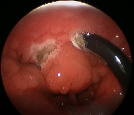 vara del diámetro PLA402 Tonsilectomy de 4.4m m para la cirugía médica