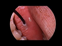 Generador de plasma de radiofrecuencia para el tratamiento de ronquidos con sonda multifunción