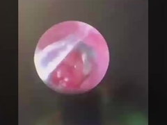 Butterfly ENT Instrumentos de cirugía ENT Proba