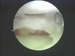 Productos de la ablación de los sistemas de la ablación de los instrumentos de Electrosurgical para la espina dorsal y las juntas