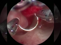 Tecnología Fría Electrodo de Cirugía de Plasma para Procedimientos de Urología con HPB