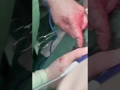 Probe de hepatología clínica PLA408 para cirugía abierta